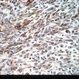 Melanoma, epithelioid cells Melanoma, epithelioid cells